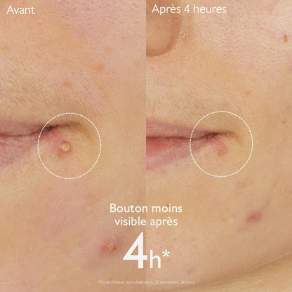 Stop Boutons Salicylique l'Acide Salicylique