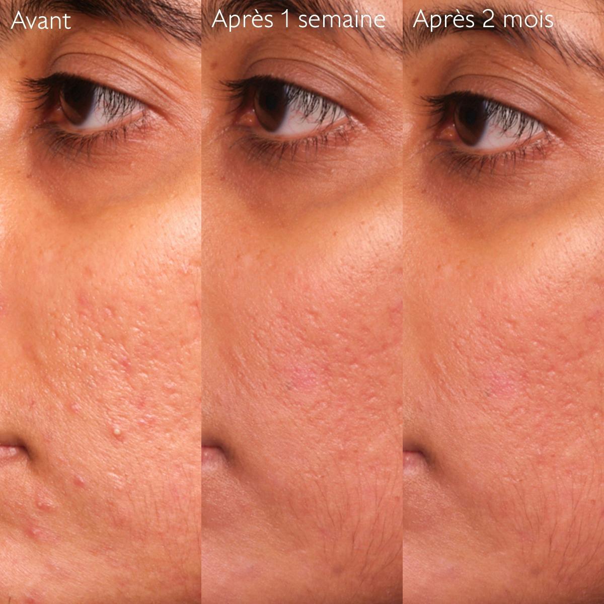 Sérum à l'Acide Salicylique Anti-imperfections